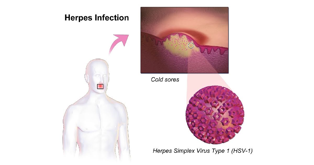 Embrace red light therapy benefits to shorten cold sore healing.